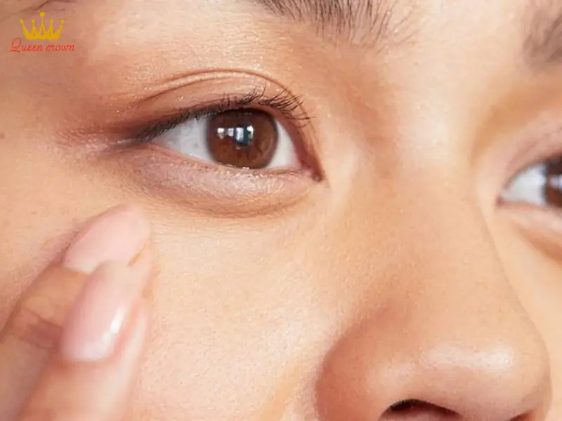 Bọng mắt là gì?