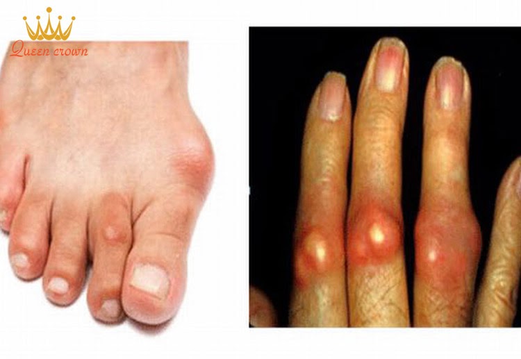 Bỏ túi 5+ cách giảm đau bệnh gút tại nhà đơn giản, hiệu quả 2 cách giảm đau bệnh gút tại nhà
