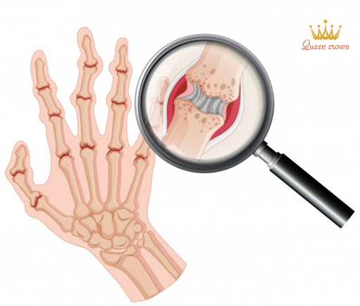 Tất tần tật về bệnh phong tê thấp 2 Bệnh phong tê thấp là một dạng viêm khớp đa khớp