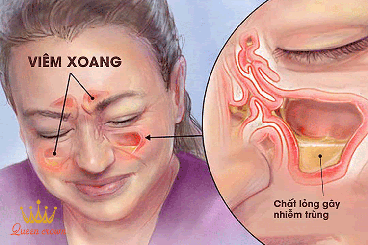 Viêm xoang có chất lỏng gây nhiễm trùng