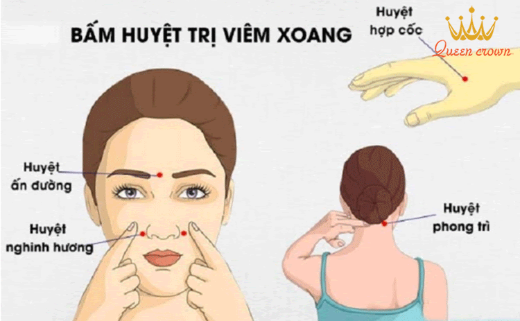 Vị trí các huyệt chữa viêm xoang